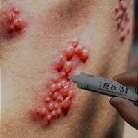 Band-shaped blistering skin itching burning pain special anti-rash ointment sequelae neuralgia pulling