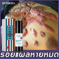 HEMEIEL  กำจัดรอยแตกลาย น้ำร้อนลวก แผลไฟไหม้ แผลผ่าตัด ซ่อมแซมผิวที่เสียหาย เร่งการซ่อมแซมให้ผิว ลบรอยแผลเป็น ลดรอยแผลเป็น ครีมลดรอยสิ ครีมลบรอยแผลเป็น ครีมลบแผลเป็น