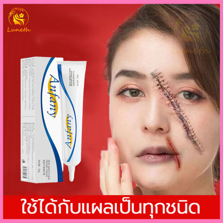 ซ่อมแซมผิวที่เสีย Anfany เจลลดรอยแผลเป็น 30G แผลผ่าตัด เหมาะสำหรับผิวรอยแตกลาย  น้ำร้อนลวก ทุกประเภท เจลลบรอยแผลเป็น ครีมลดแผลเป็น ครีมทาแผลเป็น  ครีมทาแผลเป็น ครีมลบรอยแผลเป็น ครีมลบแผลเป็น ครีมทาแผลรอยดำ ครีมลดรอยแผลเป็น  ลบลอยแผลเป็น ยาแก้แผลเป็น ...