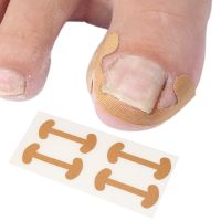 ▨ Nail Groove Patch Nail Inlay Correction Bone Patch Toenail Inlay Correction Device Toenail Deformation Without Glue