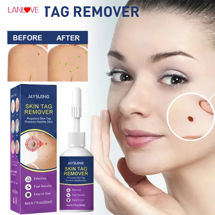 LANLOVE Mole Tag Wart Remover Antibacterial Solution Remove Fleshy ...