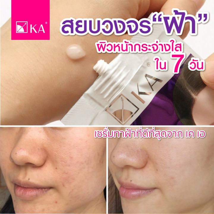 ขนาดทดลอง-เซรั่มทาฝ้า-ka-expert-anti-melasma-serum-7-กรัม