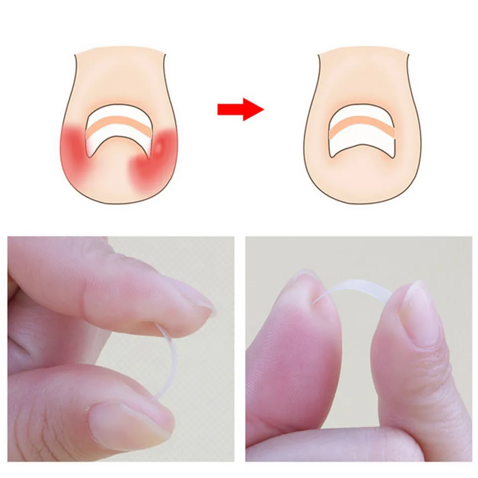 INGROWN TOENAIL TREATMENT  Ingrowing Toe Nail Correction Tool