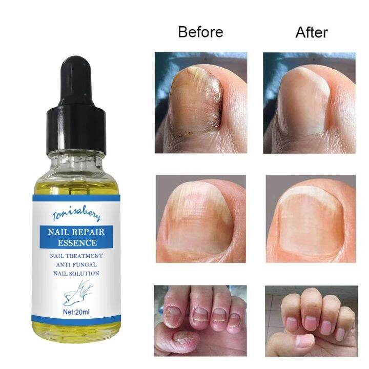 20ml-nail-fungus-repair-fluid-treatment-foot-care-essence-nail-foot-care-toe-nail-fungus-removal-gel-anti-infective-paronychia