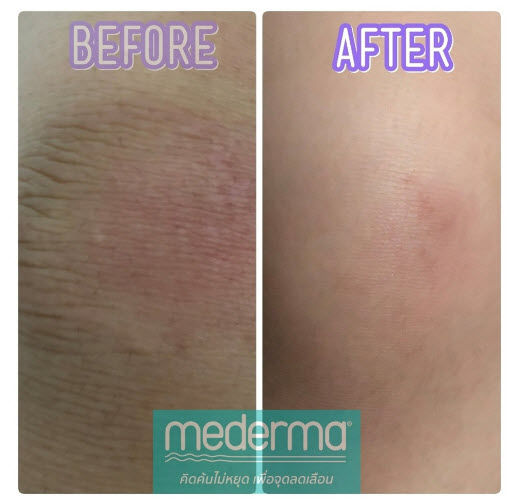 mederma-intense-gel-มีเดอร์ม่า-เจลดูแลรอยแผลเป็น-รอยดำจากสิว-แผลจากอุบัติเหตุ-แผลจากการผ่าตัด-10-กรัม-20-กรัม