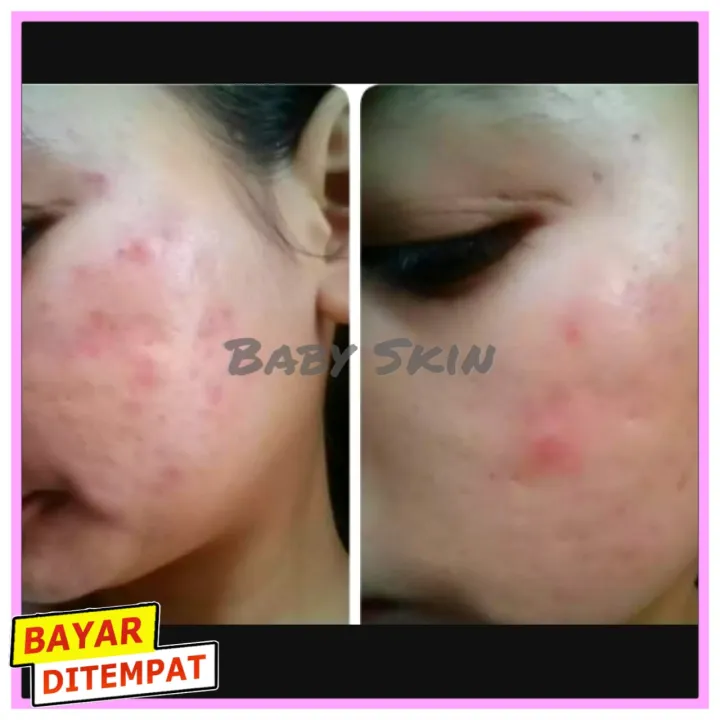 Obat Jerawat Batu Paling Ampuh Dan Cepat Penghilang Jerawat Obat Bisul Minyak Oles Khusus Jerawat Cap