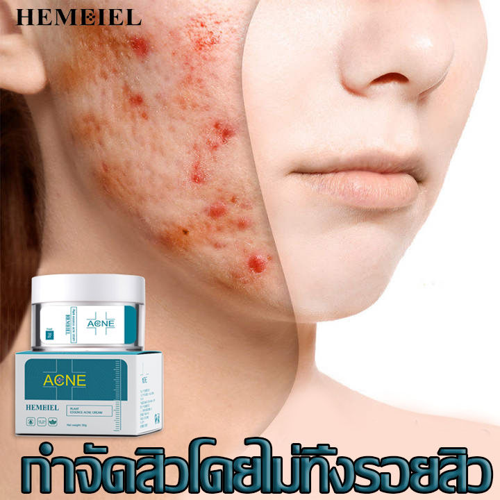 hemeiel-ครีมกำจัดสิวเสี่ยน-ทุกประเภท-สำหรับสิวอักเสบ-ลดสิว-รอยสิว-สามารถลดสิว