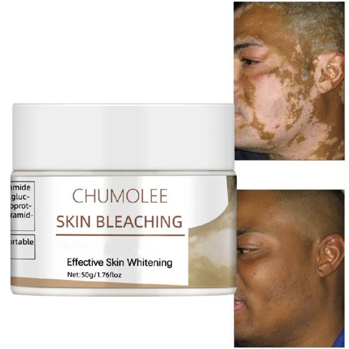 *Chumolee Skin Bleaching Whitening Face Cream White Spot Vitiligo