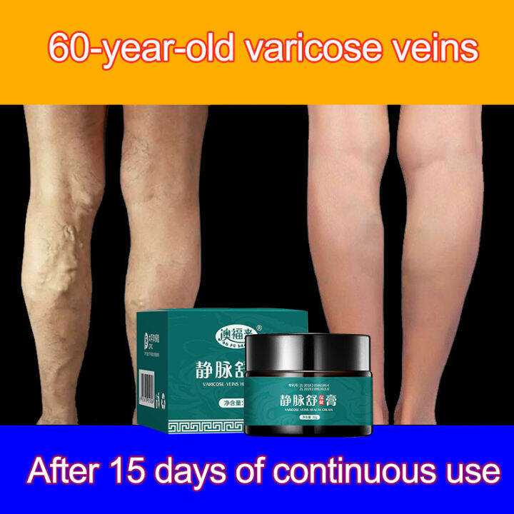Ointment special ointment for varicose veins specific medicine for varicose veins treatment Ao