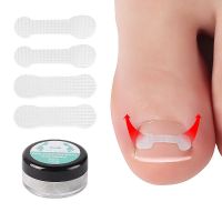 【CW】 20 4PCS Nail Correction Stickers Ingrown Toenail Straightening Curved Brace Paronychia Treatment Recover Corrector Pedicure Tool