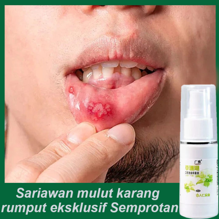 Semprotan Kandidiasis Pada Lidah30ml Semprotan Jamur Mulut Lidah Semprotan Sariawan Mulut 0276