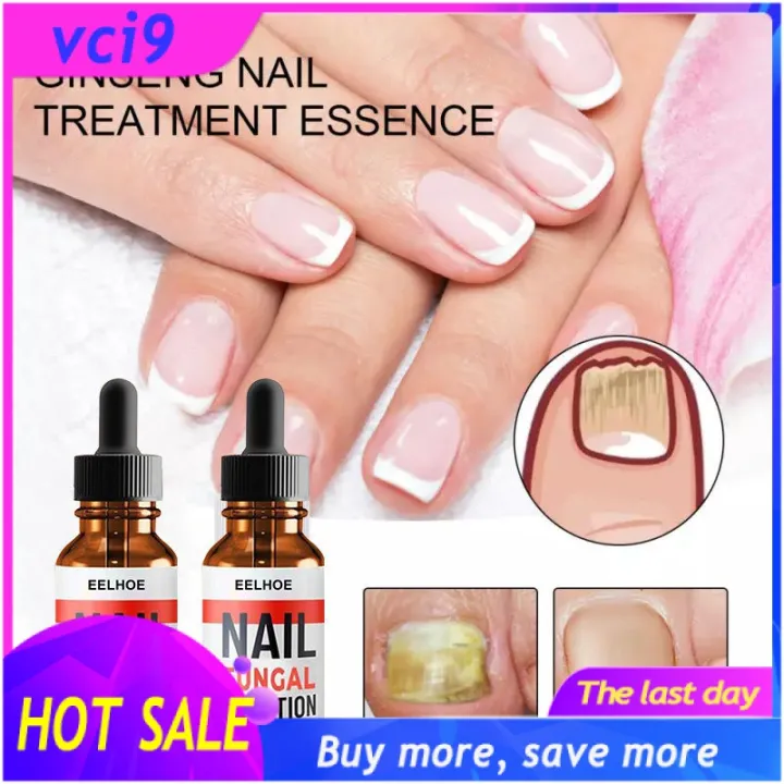 Hot 】Buy 2 Take 1COD Antibacterial Nail Treatments Nail Repair Treatment Nail Nourishing Oil Antibacterial Nail Hot 】Buy 2 Take 1COD Antibacterial Nail Treatments Nail Repair Treatment Nail Nourishing Oil Antibacterial Nail