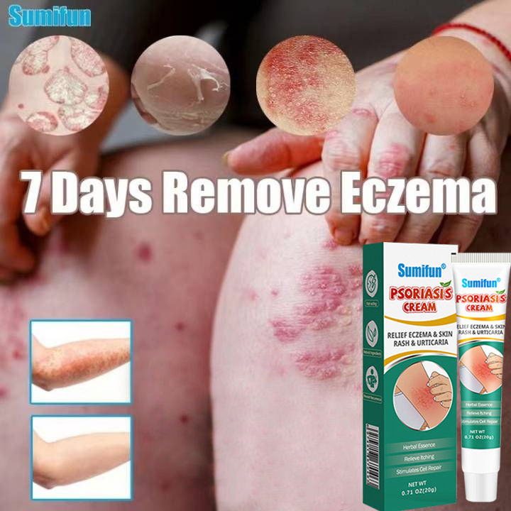 100 Effective Sumifun Eczema Treatment Cream Gamot Sa Kati Kati Sa Balat Buni Psoriasis 8249
