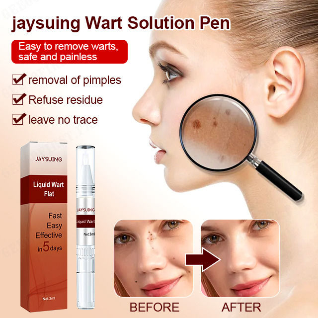 Mole Remover For Face Body, Tags Moles Remover Pen Fast Easy Effective In 5  Days Easy To Remove Tags, Moles, Warts