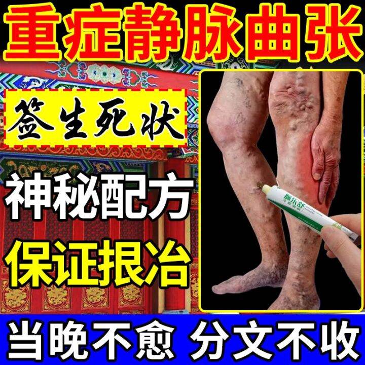 Special Effect Ointment For Varicose Veins Blue Raised Earthworm Legs