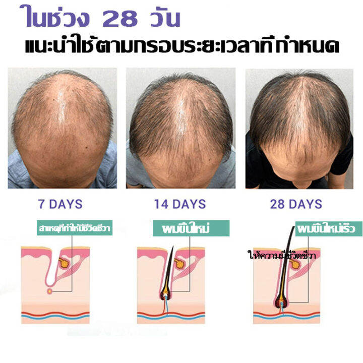 hemeiel-ที่เร่งผมยาว-ครีมเร่งผมยาว-ไม่ต้องกังวลกับปัญหาผม-นีโอแฮร์ของแท้-น้ำยาปลูกผม-ช่วยปรับปรุงผมร่วง