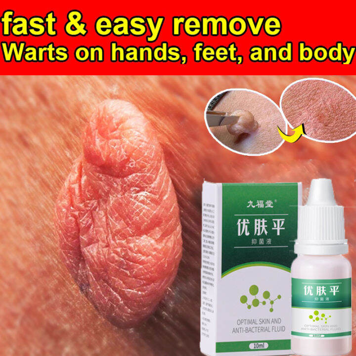 Ubat Buang Kutil Tahi Lalat Wart Remover Liquid Buang Tahi Lalat