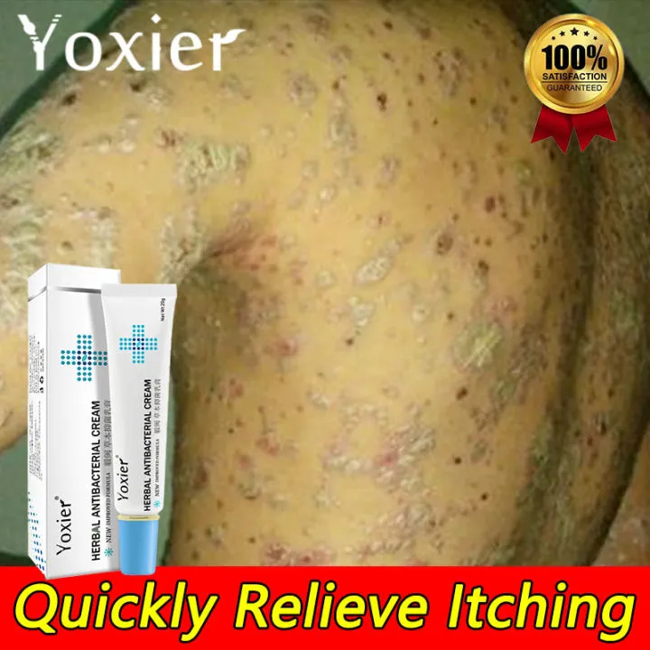 Anti Fungal Ointment Yoxier Herbal Antibacterial Cream 20g Antibacterial And Antipruritic