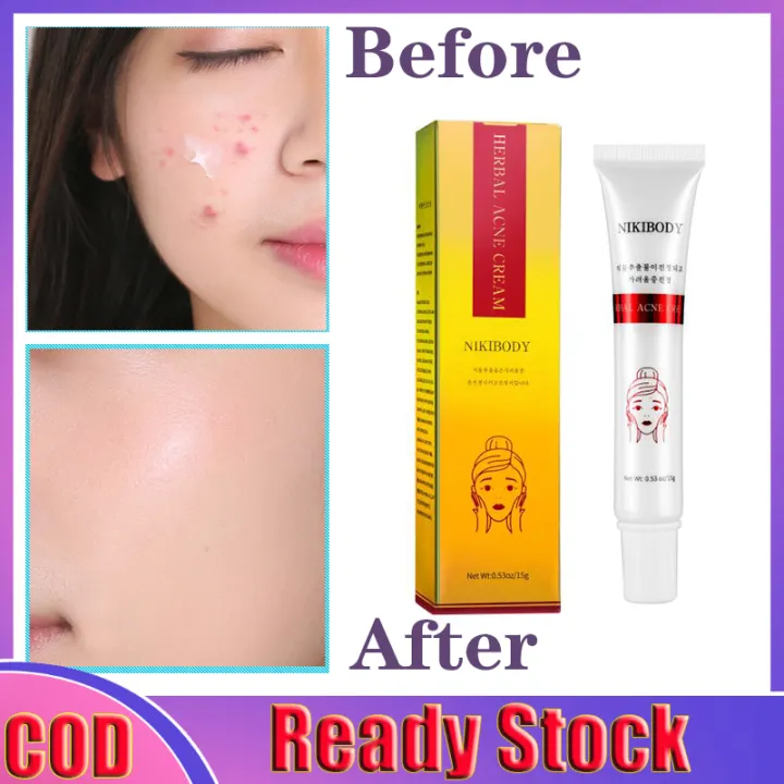 Herbal Acne Treatment Gel Acne Pimples Remover Cream Reduce Acne Marks