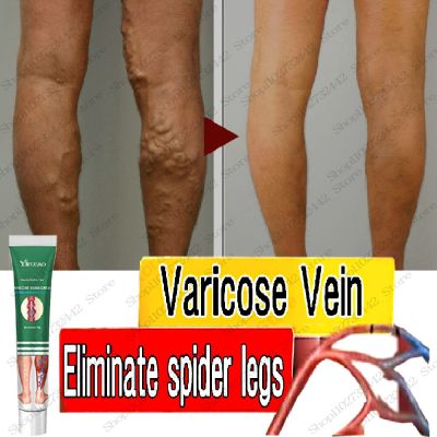 ครีมทรีทเมนท์เส้นเลือดขอดที่เท้าช่วยบรรเทาอาการอักเสบสูตรธรรมชาติ Vasculitis Phlebitis ขาสำหรับเส้นเลือดขอดที่เท้า S