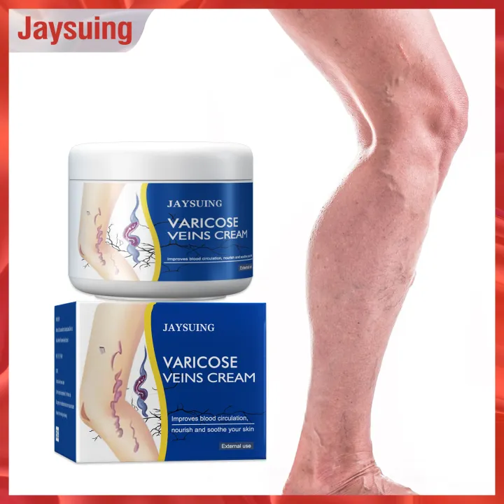 Jaysuing Varicose Veins Cream Herbal Medicine For Treating Varicose ...