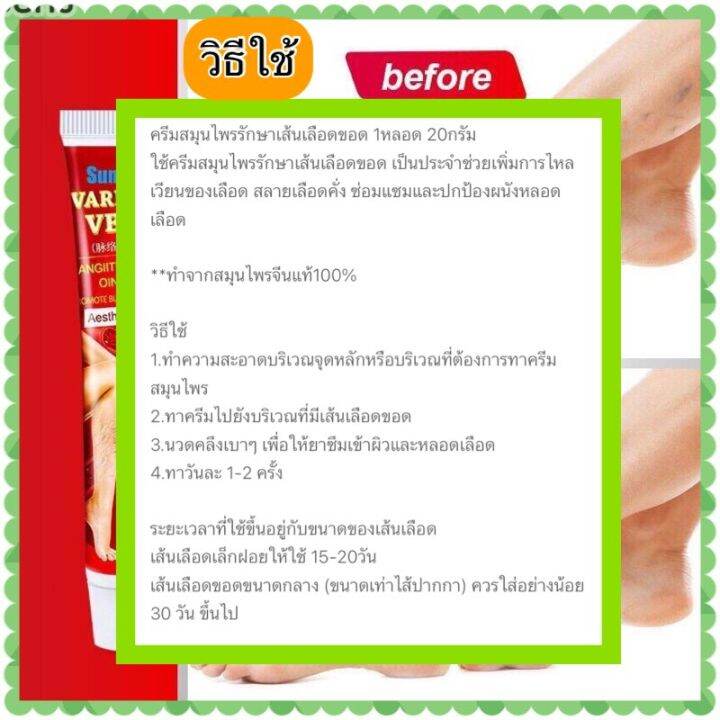 ส่งฟรี-hbesty-ครีมทาแก้เส้นเลือดขอด-บรรเทาอาการบวมของเส้นเลือดบอกลาเส้นเลือดขอดเส้นเลือดดำอุดตันและอาการปวด