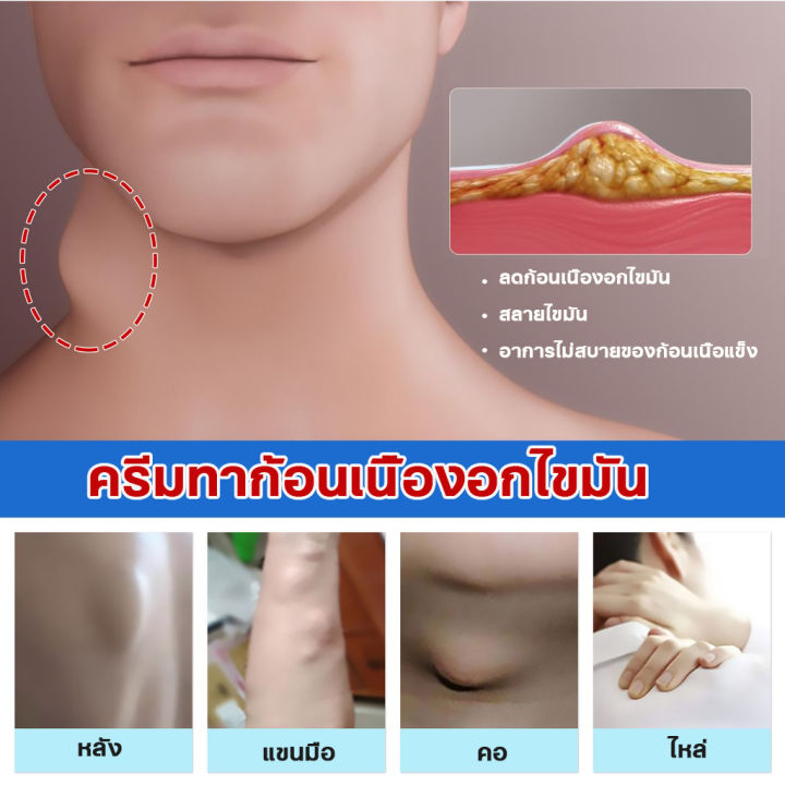 lipoma-removal-cream-ครีมก้อนเนื้องอกไขมัน-สมุนไพรกำจัด-ก้อนเนื้อใต้ผิวหนัง-ก้อนซีสต์-30g-ก้อนไขมันแข็ง-เนื้องอกไขมัน