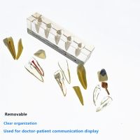 Dental 5 Stage Endodontic Treatment Model Dental Study Teach Teeth Model