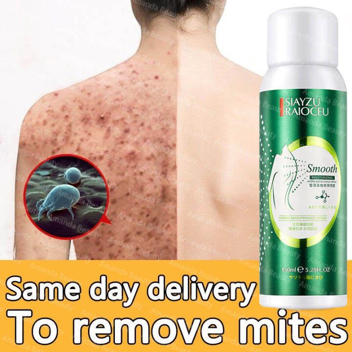 150ML Non-toxic Natural Back acne Spray Mite Remove Spray Back Acne ...