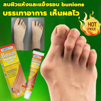 เห็นผลไว Bunion cream ลดปวด ลดอักเสบ นิ้วโป้งโค้งงอเข้า Hallux valgus ปวดเท้า ปวดข้อ ปวดบวม ข้ออักเสบ ข้อบวม ข้อต่อนิ้วเท้า บรรเทาอาการ บรรเทาปวด ค