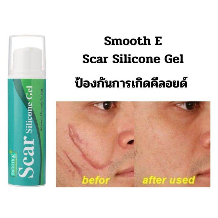 แพ็ค-2-smooth-e-scar-silicone-gel-10-g-ซิลิโคนเจล-ป้องการการเกิดแผลเป็นชนิดนูน-และคีลอยด์-ช่วยให้แผลหายเร็วขึ้น-ลดอาการคันจากแผล-ไม่เหนียวเหนอะหนะ