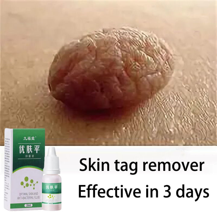 Skin Tag Remover Hilangkan Ketuat Kutil Remover Skin Tag Genital Remover Warts Removal Cream