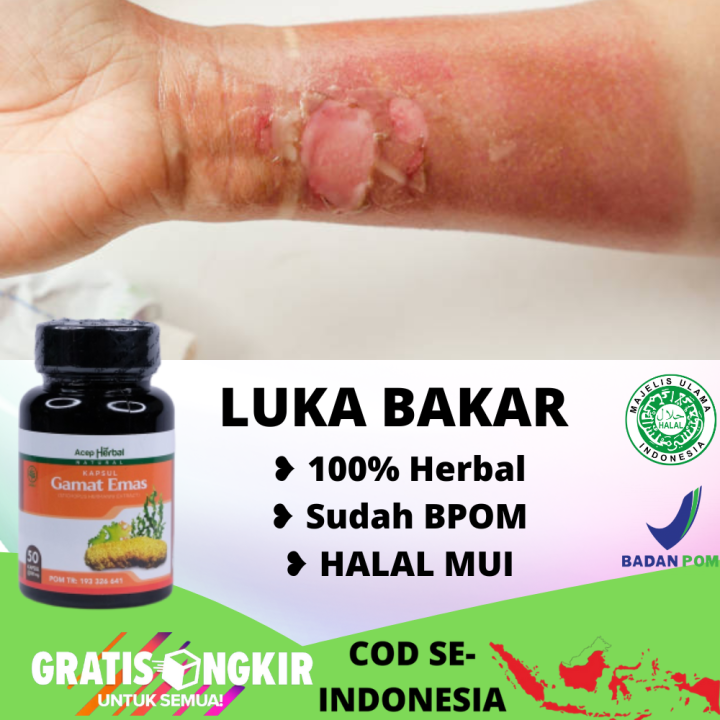 Obat Herbal Luka Bakar Penghilang Luka Bakar Kena Knalpot Dan Aiar