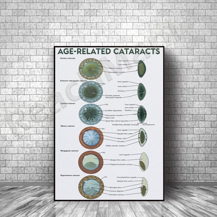 ตาโรคกายวิภาคศาสตร์แผนภาพศิลปะพิมพ์ต้อกระจกการรับรู้ตกแต่งผนังตาสุขภาพโปสเตอร์