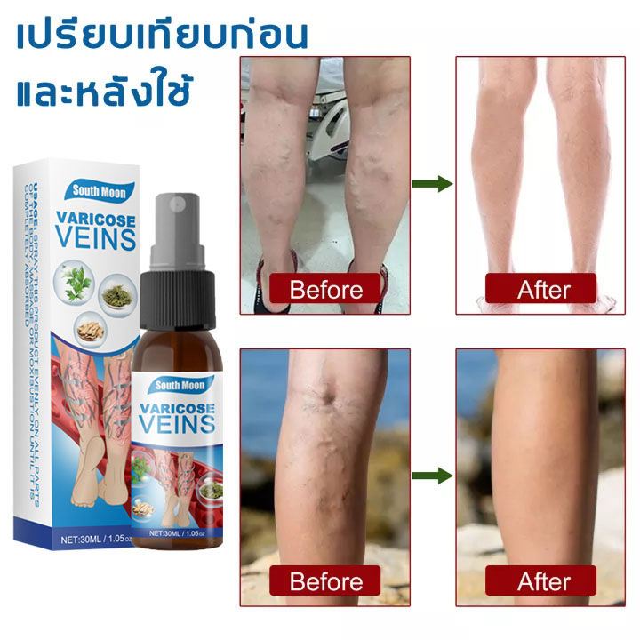 south-moonเส้นเลือดขอด30ml-บอกลาขาไส้เดือน-บอกลาเส้นเลือดขอดเส้นเลือดอุดตัน-ทาอาการปวด-ครีมทาเส้นเลือดขอด-ครีมเส้นเลือดขอด-ยาเส้นเลือดขอด-ยาทาเส้นเลือดขอด-ยารักษาเส้นเลือดขอด-แมงมุมเส้นเลือดปวด-ครีมทา