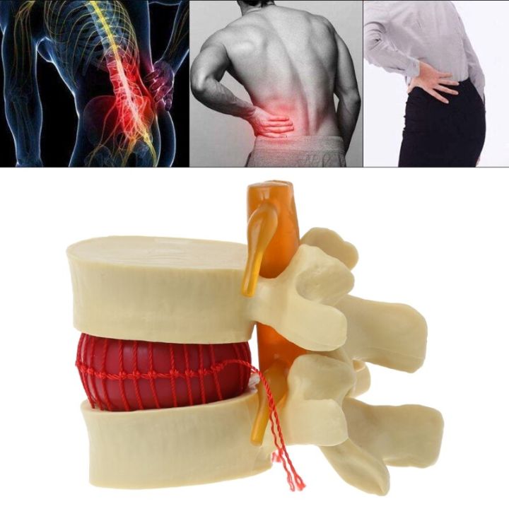 Lumbar Vertebrae Model Anatomical Spine Lumbar Disc Herniation Anatomy ...