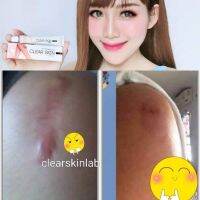 ครีมรักษาแผลคีลอด์และรอยดำ สูตรเข้มข้น  เนื้อ ซิลิโคน+เซรั่ม scar gel