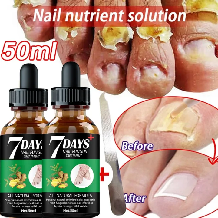 7Day 50ML การรักษาเชื้อราเล็บ Feet Care Essence เล็บ Foot Toe Nail