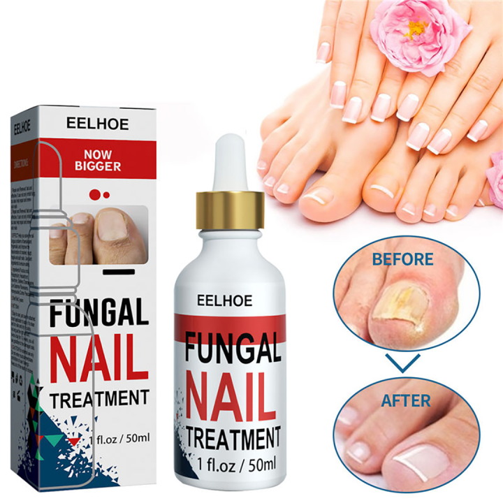 Say Goodbye to Fungal Nail Infections with Our Powerful Nail Treatment
