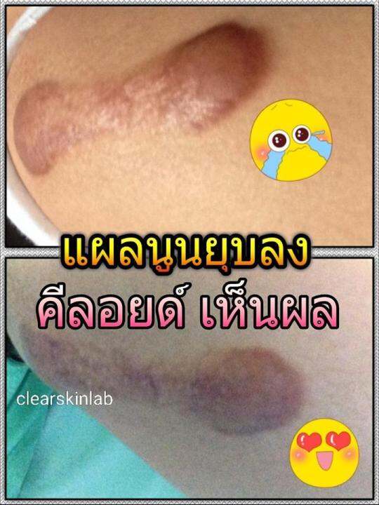 ครีมรักษาแผลเป็น-สูตรเข้มข้น-รอยดำ-และ-แผลนูน-ขนาด-14-กรัม-เนื้อ-ซิลิโคน-เซรั่ม-scar-gel