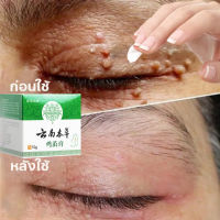 ขี้แมลงวัน หูดตาปลาและติ่งเนื้อ ของแท้ Corns warts removal พร้อมส่ง ไฝ ครีมแต้มหูด ลอกหูดตาปลา ปลอดภัยไม่เจ็บ