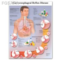 โปสเตอร์ผ้าใบพิมพ์ลายโรคกรดไหลย้อน Gastroesophageal ภาพวาดรูปภาพติดผนังสำหรับการศึกษาทางการแพทย์ออฟฟิศห้องเรียน