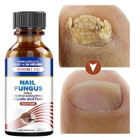 Nail Fungus Treatment Serum Hand amp; Foot Care Fungus Removal amp; Repair Gel Anti-Infection Parasitic Diseases Mycosis