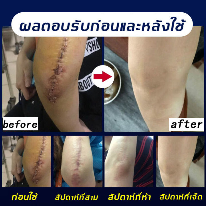 peimei-ครีมลบแผลเป็น-ซ่อมแซมแผลเป็น-แผลเป็นผ่าตัด-แผลไฟไหม้-น้ำร้อนลวก-แผลเป็นนูนหนา-แผลเป็นถลอก-เร่งการซ่อมแซมให้ผิว-เจลลบรอยแผลเป็น-ครีมลดรอยแผลเป็น-ครีมทาแผลเป็น-ครีมลดรอยสิว-ครีมลดแผลเป็น-ครีมกำจั