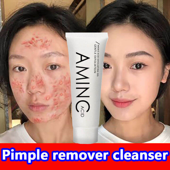 facial foam cleanser facial wash white heads pimple black head remover