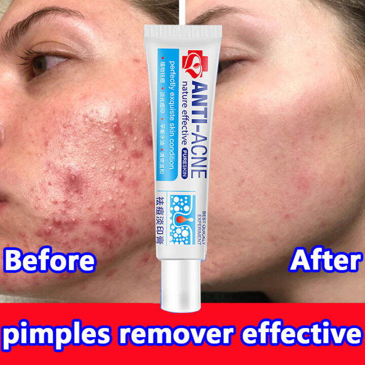 Pimple Remover Acne Scar Remover anti acne and pimples Repair Pimple