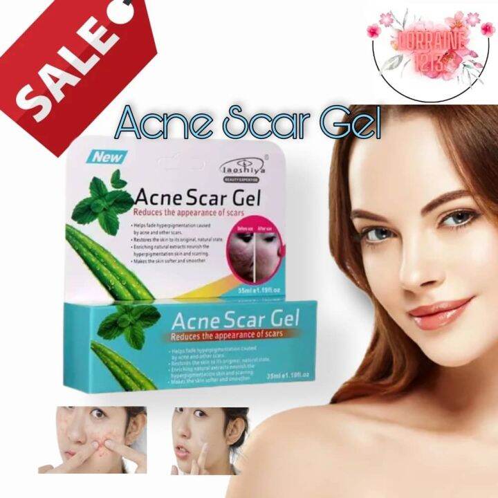 Newest and Effective!! Acne Scar Gel/Remove Scar Acne Fade Stretch ...