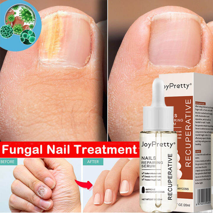 ASSWS Store JoyPretty Foot Nail Fungus Treatment Serum Anti Fungi Nails