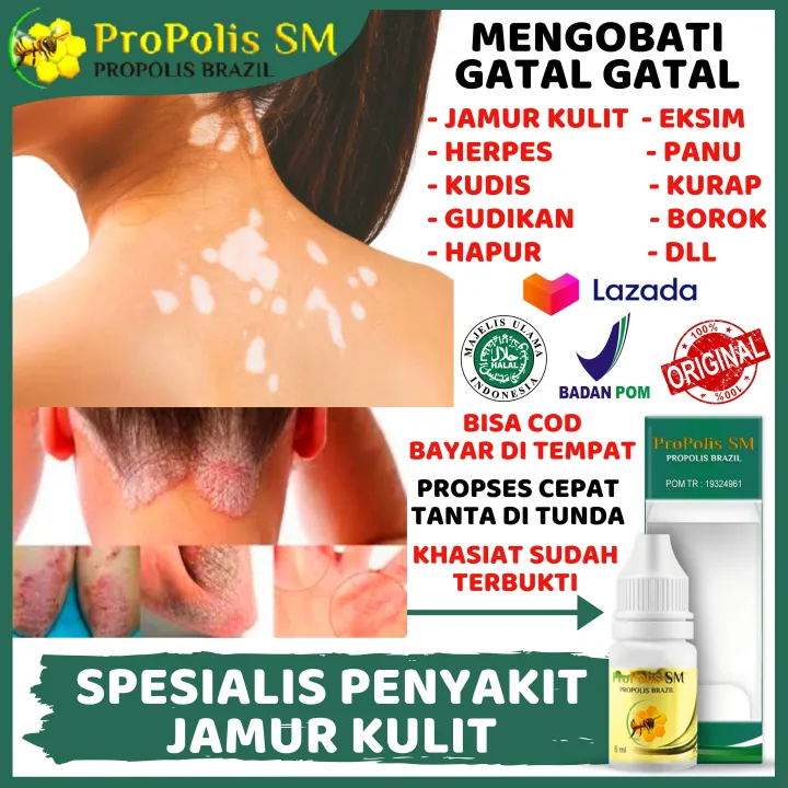 Obat Gatal Jamur Di Badan Kepala Selangkangan Kemaluan Vagina Kaki Pantat Kurap Hapur 9590