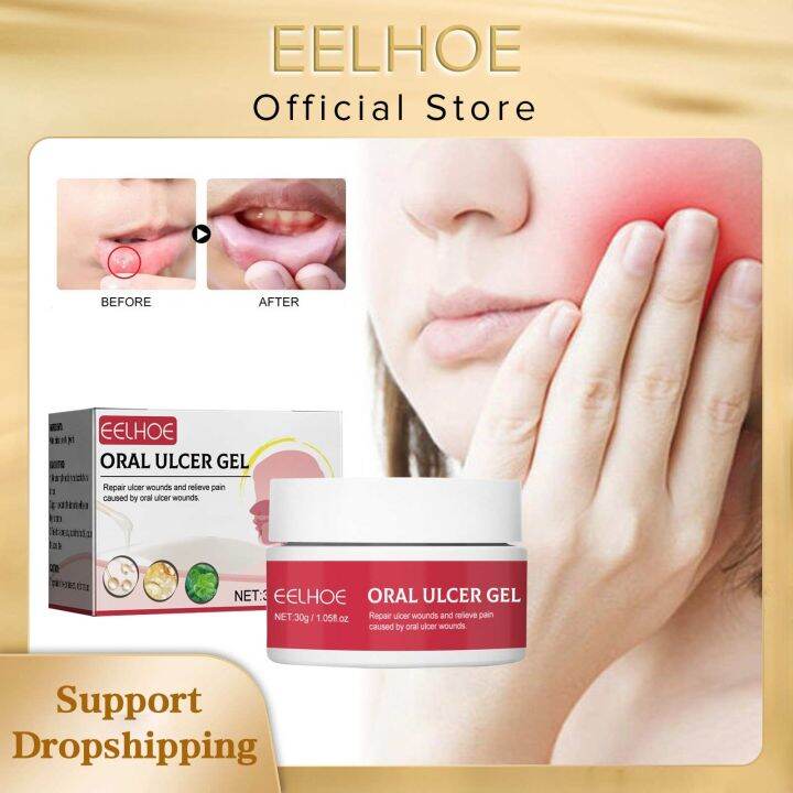 Mouth Ulcer Gel Reduce Gingival Inflamation Antibacterial Soothing